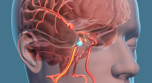 Aneurisma Cerebral